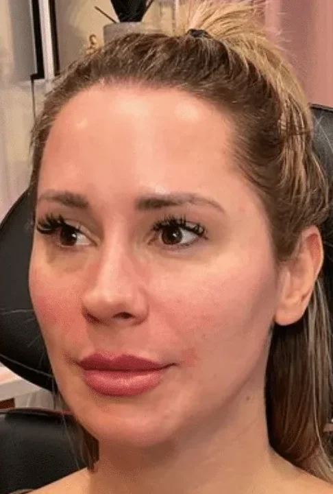Sculptra Collagen Restoration after &mdash; Esthetic Finesse