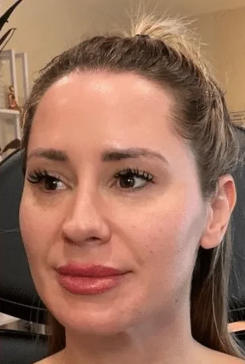 Sculptra Collagen Restoration before &mdash; Esthetic Finesse