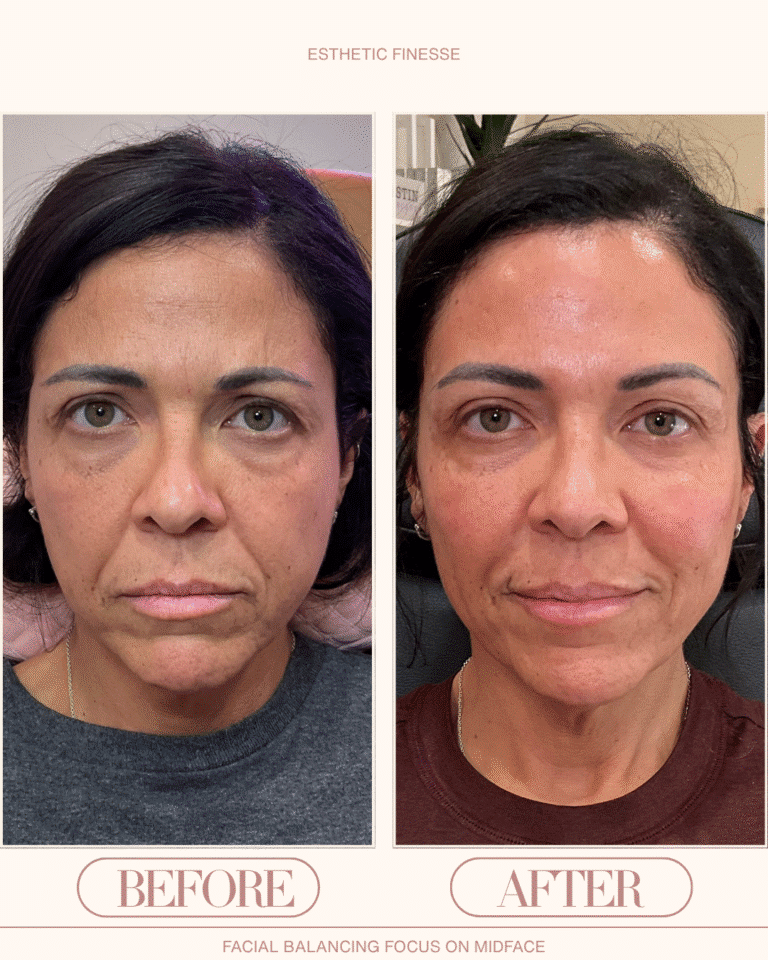 puppet line filler before and after