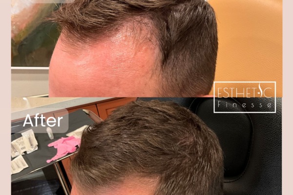 Copy of Chad Eisenberg Hair Restoration with Exosomes_20250103_035152_0002