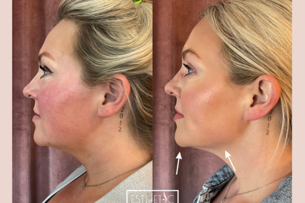 Copy of Chailey Full facial balancing with Radiesse and HA filler. Jawline,_20250103_032434_0002