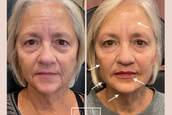 Julie Wilkens Full Restore Botox, Cheek filler, Jawline, Chin, Lips_20250103_035828_0000