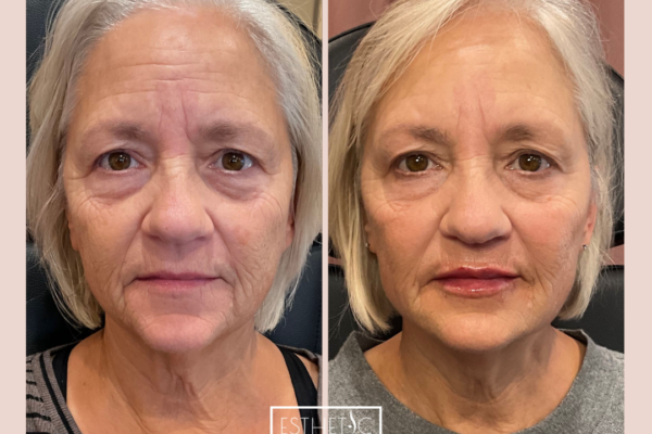 Julie Wilkens Full Restore Botox, Cheek filler, Jawline, Chin, Lips_20250103_035828_0001