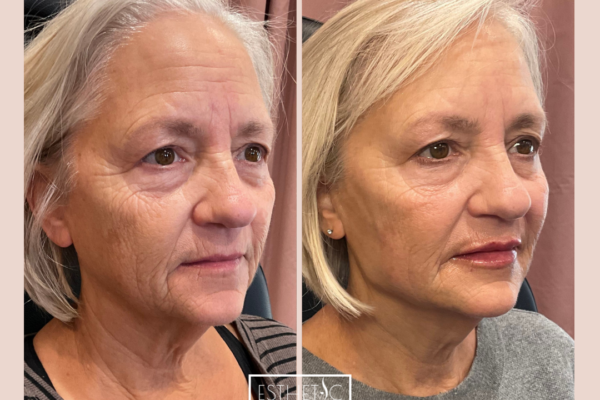 Julie Wilkens Full Restore Botox, Cheek filler, Jawline, Chin, Lips_20250103_035828_0002