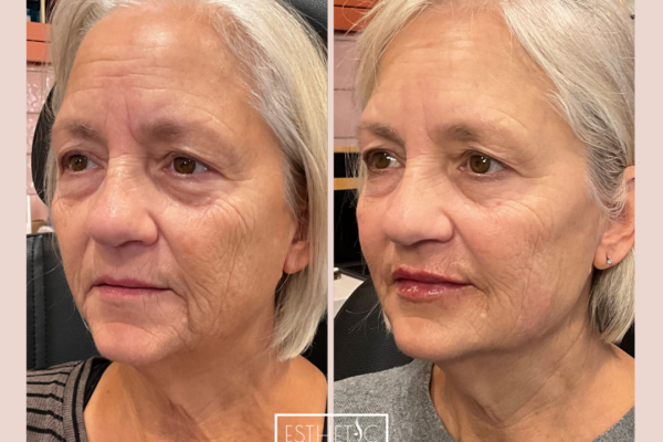 Julie Wilkens Full Restore Botox, Cheek filler, Jawline, Chin, Lips_20250103_035828_0003