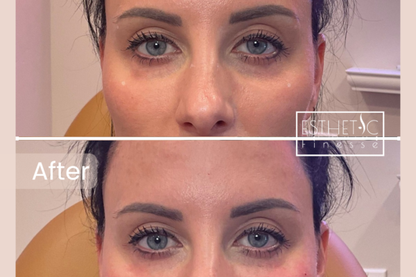 Kristine Basile's Undereye_20250103_040007_0000