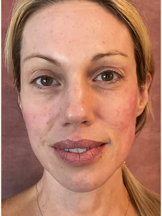 Sculptra Collagen Restoration after