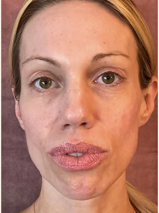 Sculptra Collagen Restoration before