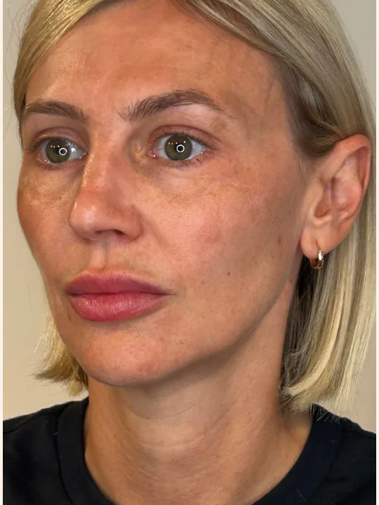 Collagen Restoration after