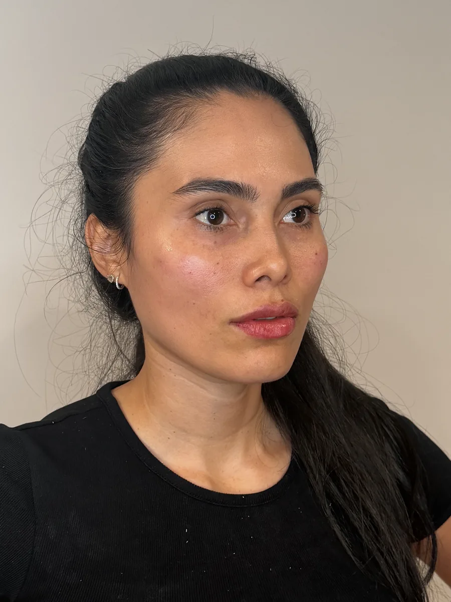 Lips, Under-Eye & Midface after