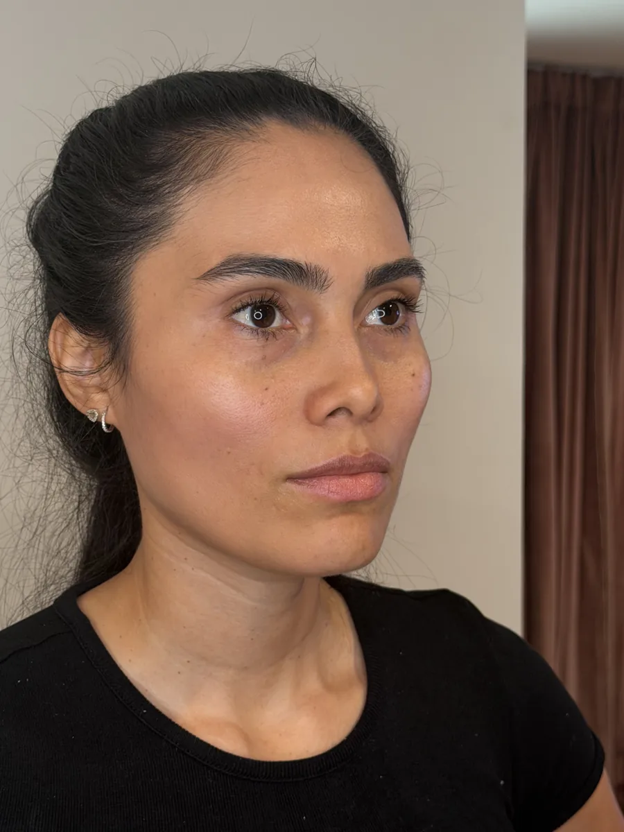 Lips, Under-Eye & Midface before