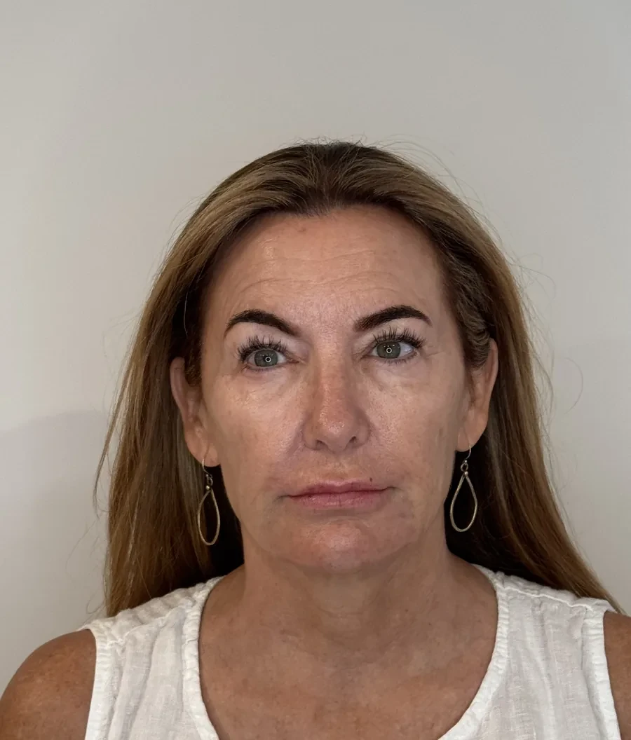 Chin & Lower Lip Filler after
