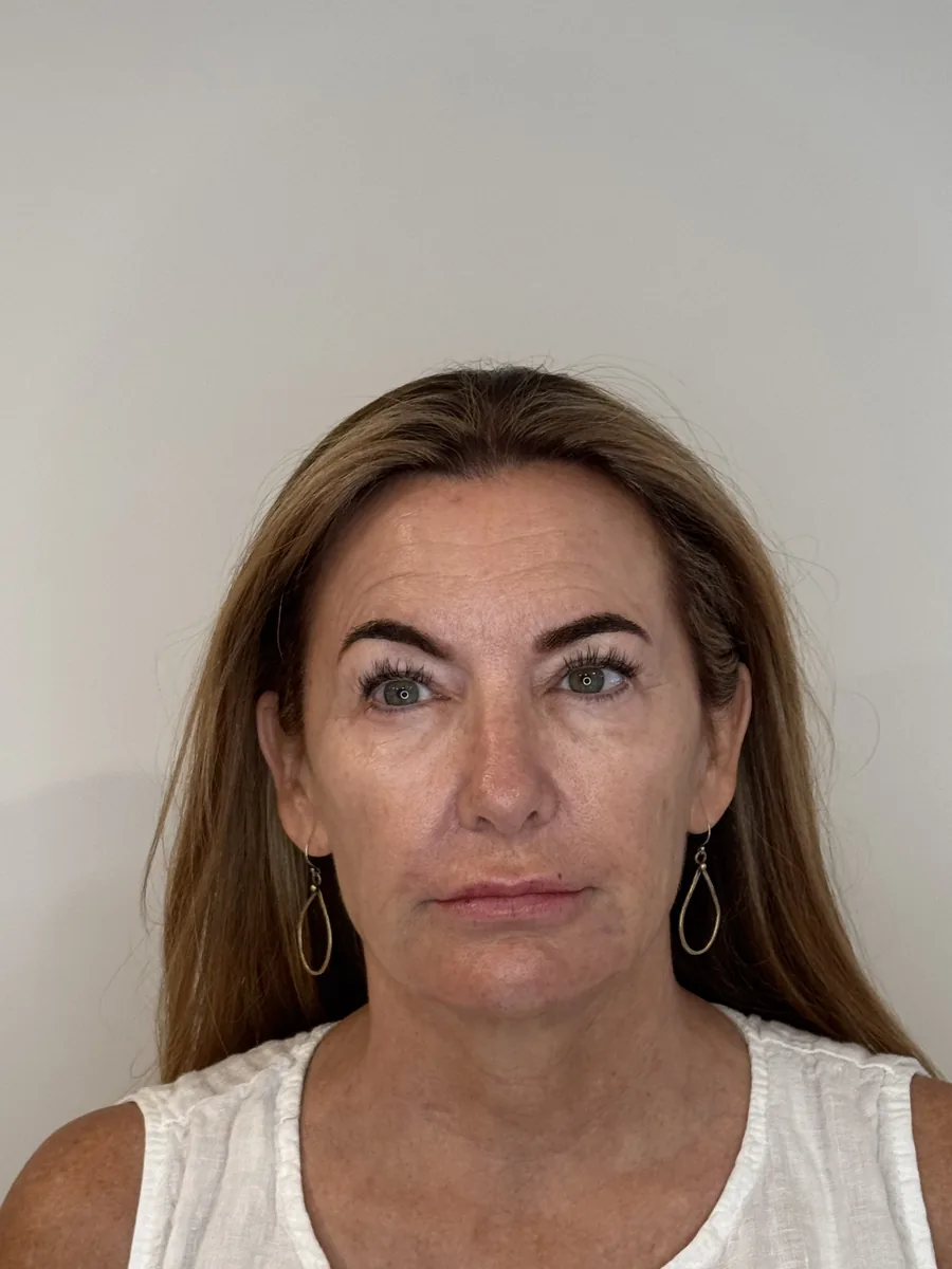 Chin & Lower Lip Filler after