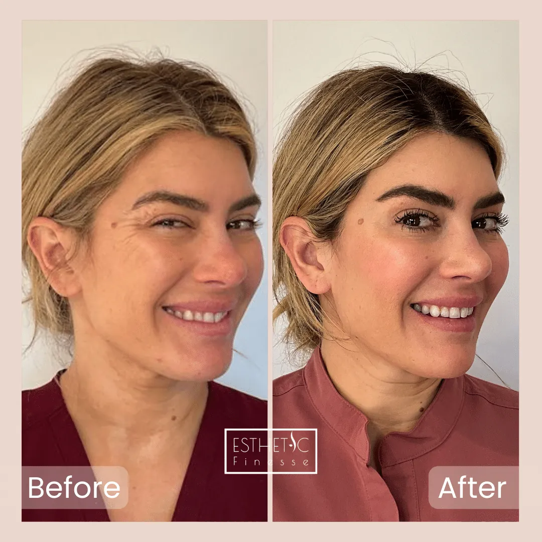 Before and after, forehead lines, Esthetic Finesse Scottsdale