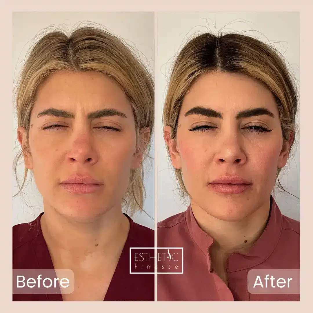 Before and after, frown lines, Esthetic Finesse Scottsdale