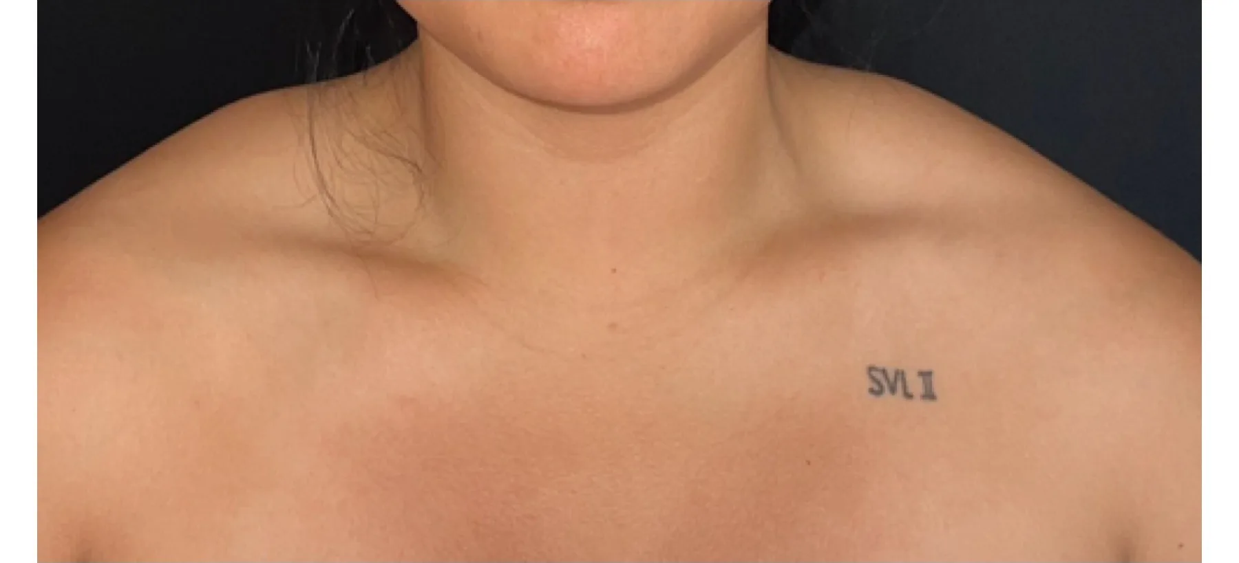 Botox in traps before — Esthetic Finesse