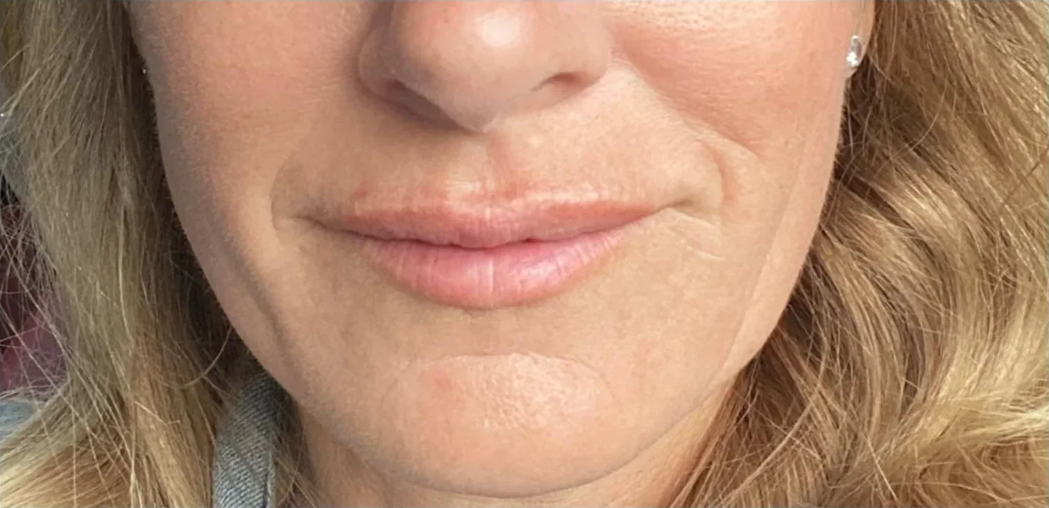 Chin and Profile after — Esthetic Finesse