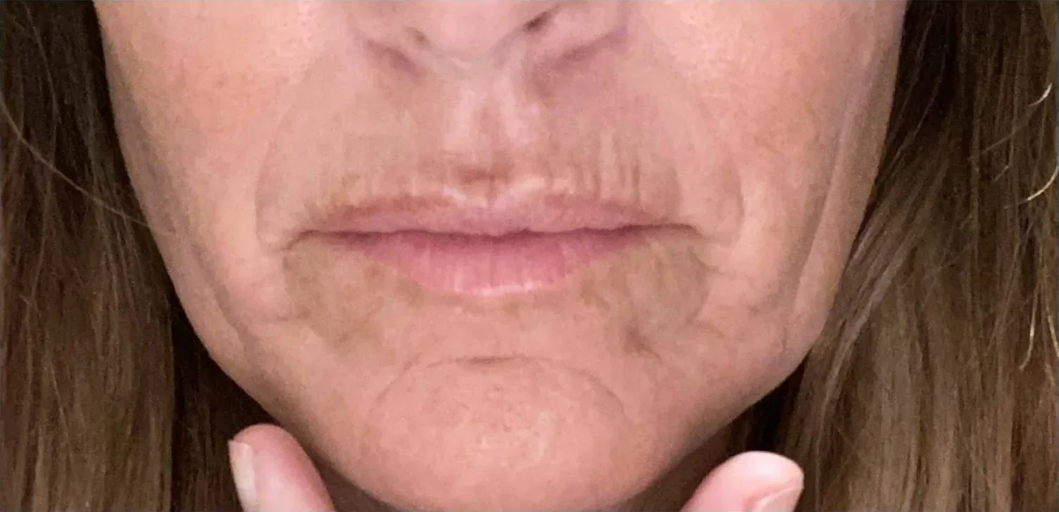 Chin and Profile before — Esthetic Finesse