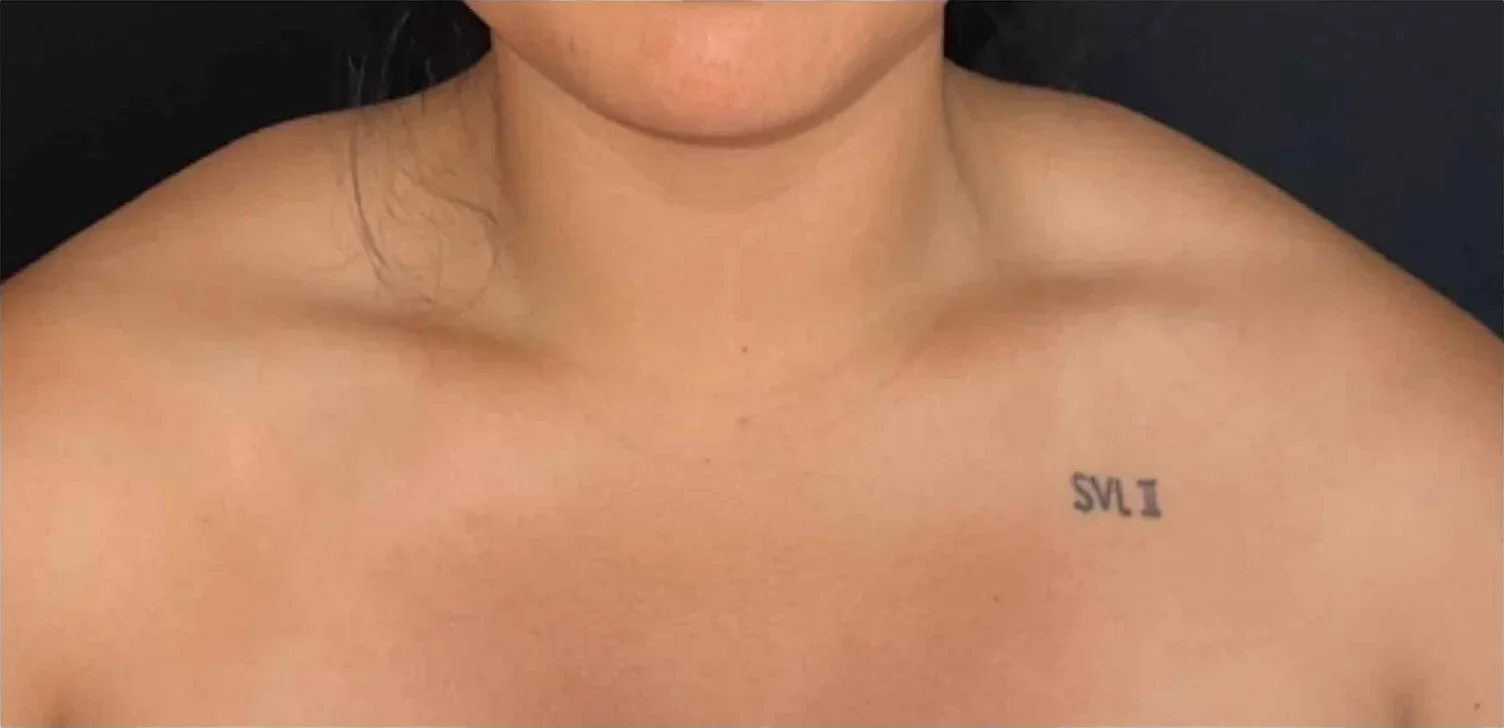 Trap Botox before — Esthetic Finesse