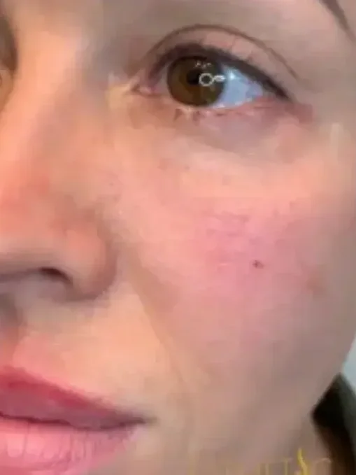 Rested Look after — Esthetic Finesse