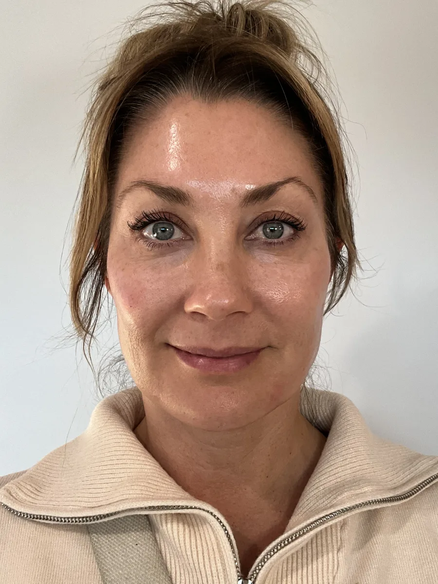 Collagen & Contour after — Esthetic Finesse