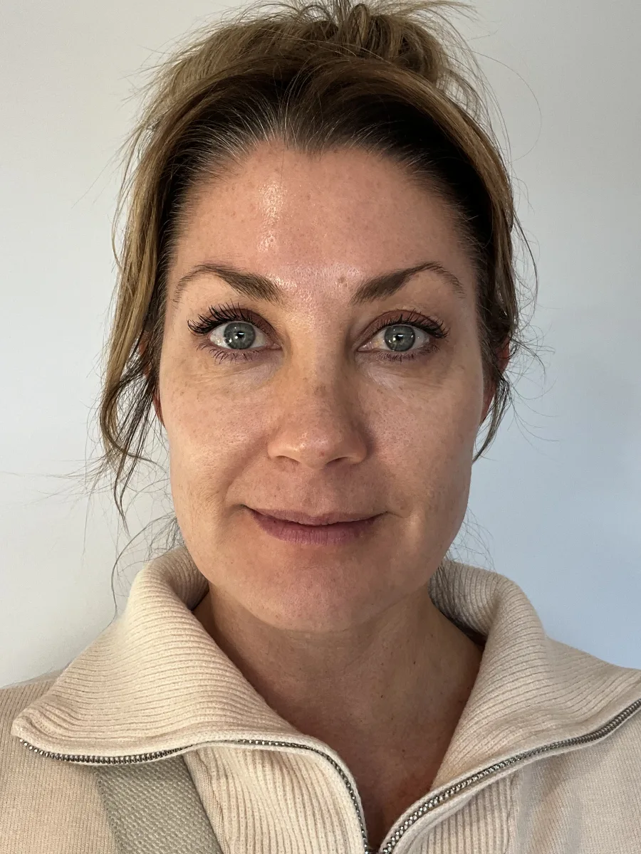 Collagen & Contour before — Esthetic Finesse