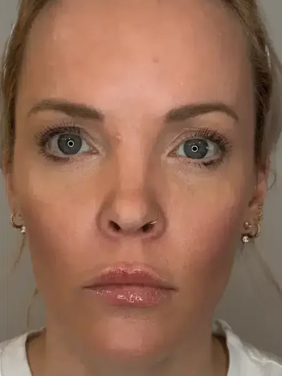 Facial Balancing after — Esthetic Finesse