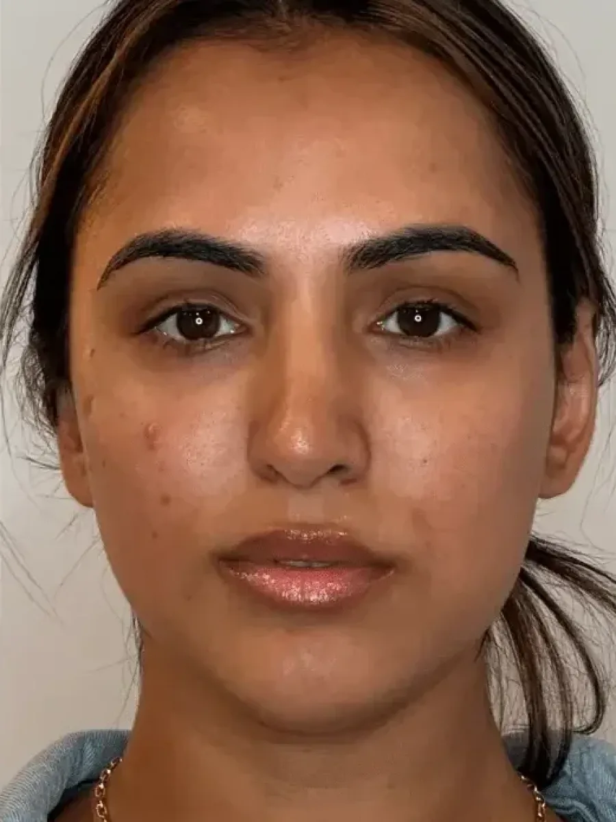 Facial Balancing after — Esthetic Finesse