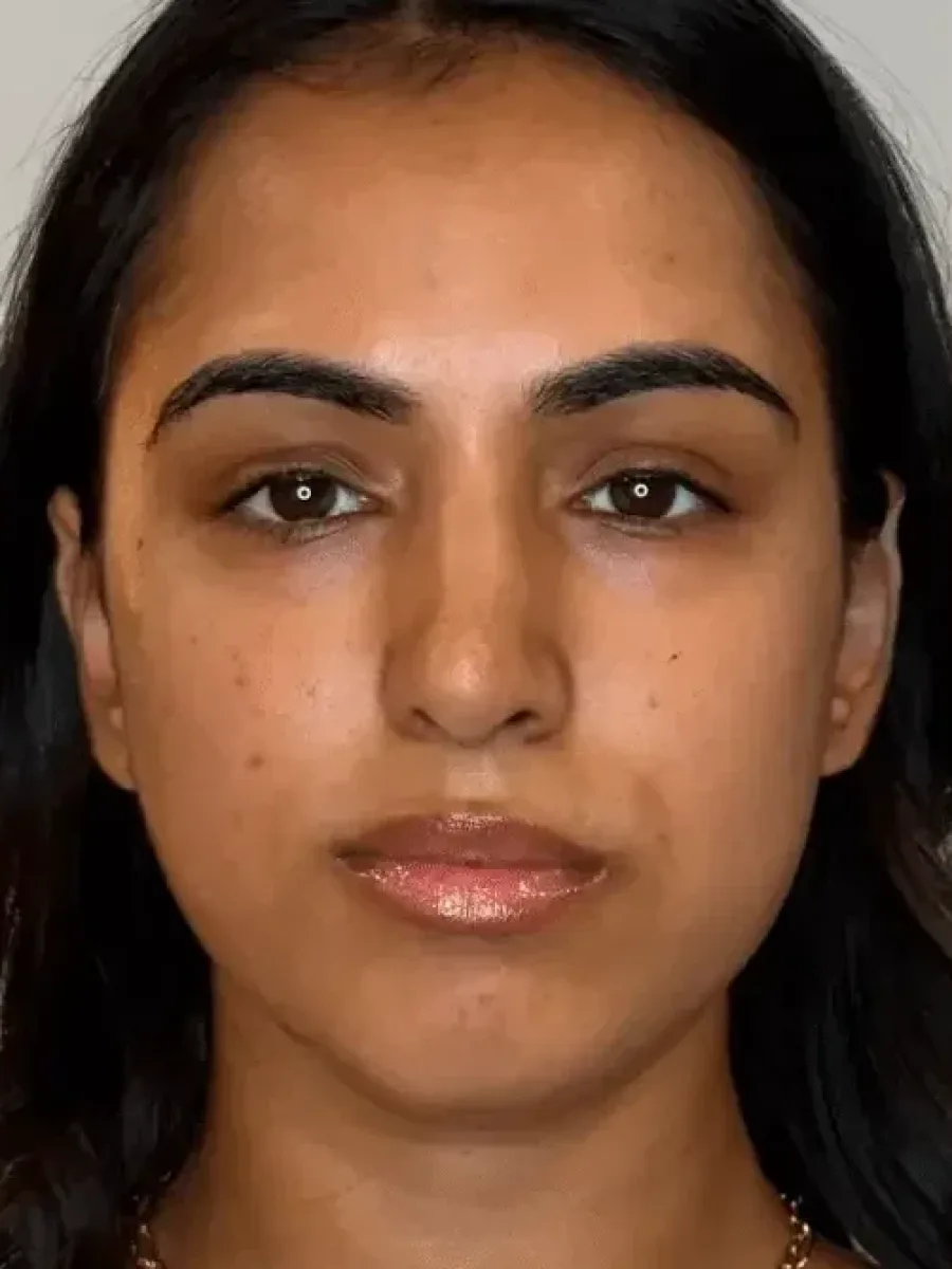 Facial Balancing before — Esthetic Finesse