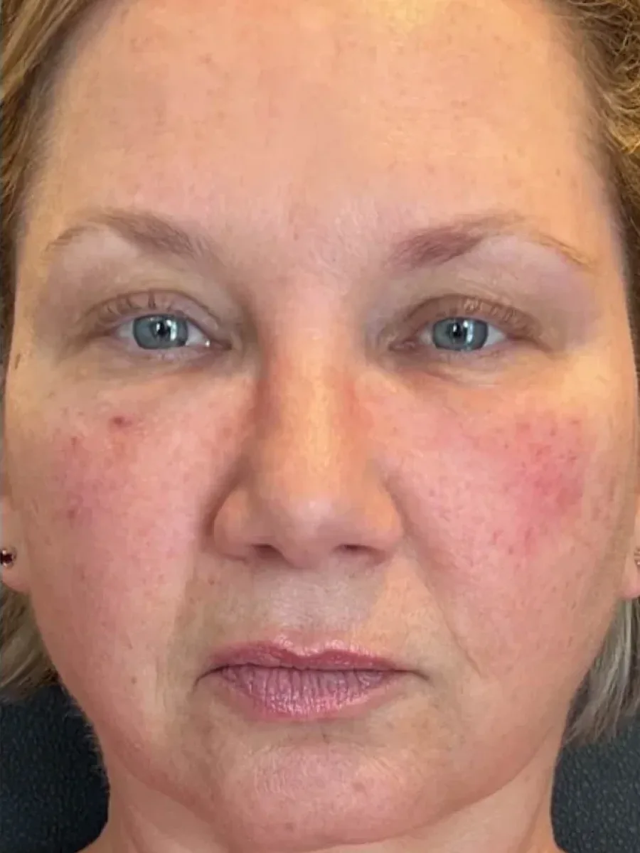 Balanced Contour after — Esthetic Finesse
