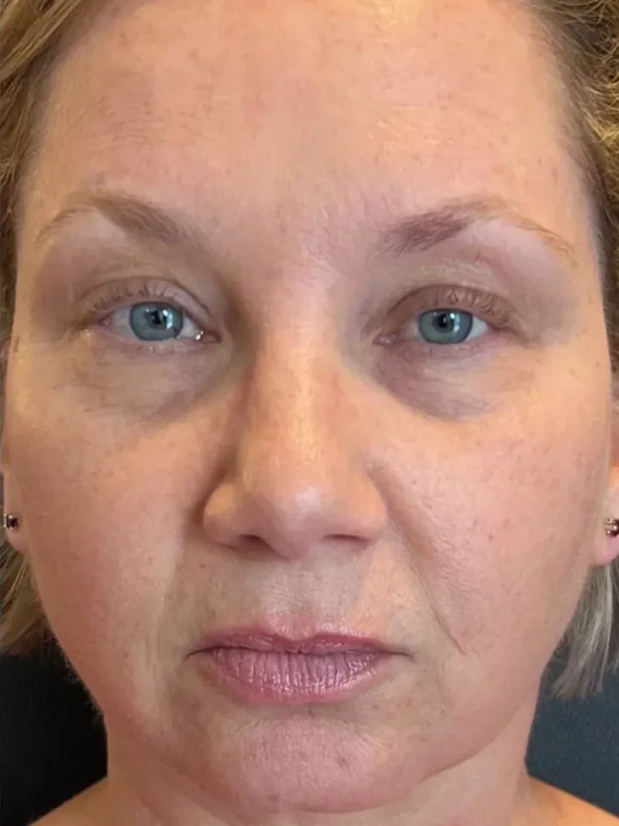 Balanced Contour before — Esthetic Finesse