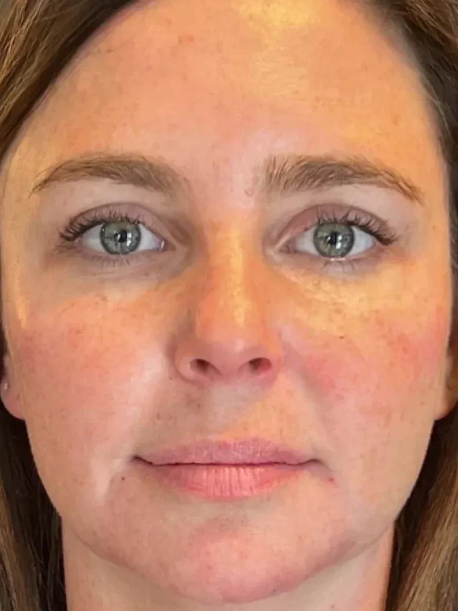 Soft Lift after — Esthetic Finesse