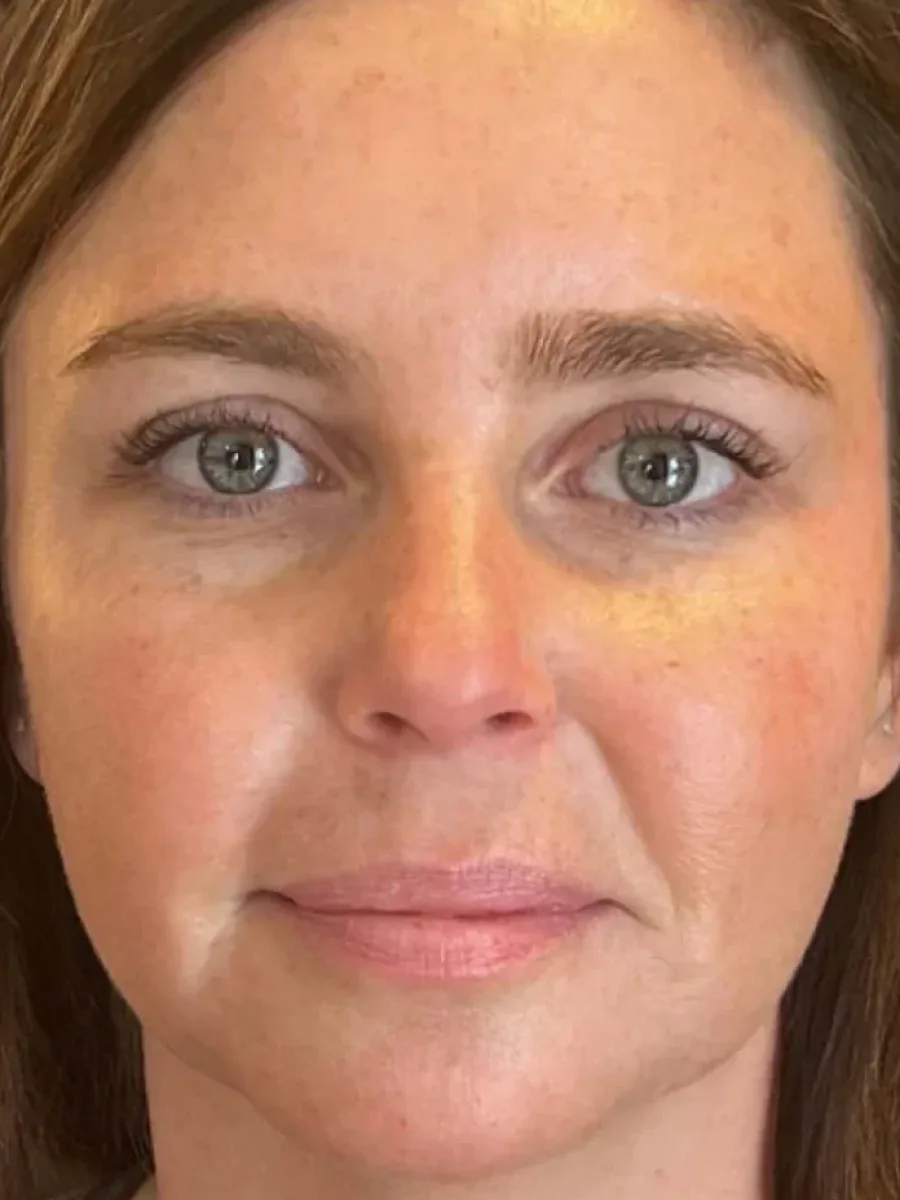 Soft Lift before — Esthetic Finesse