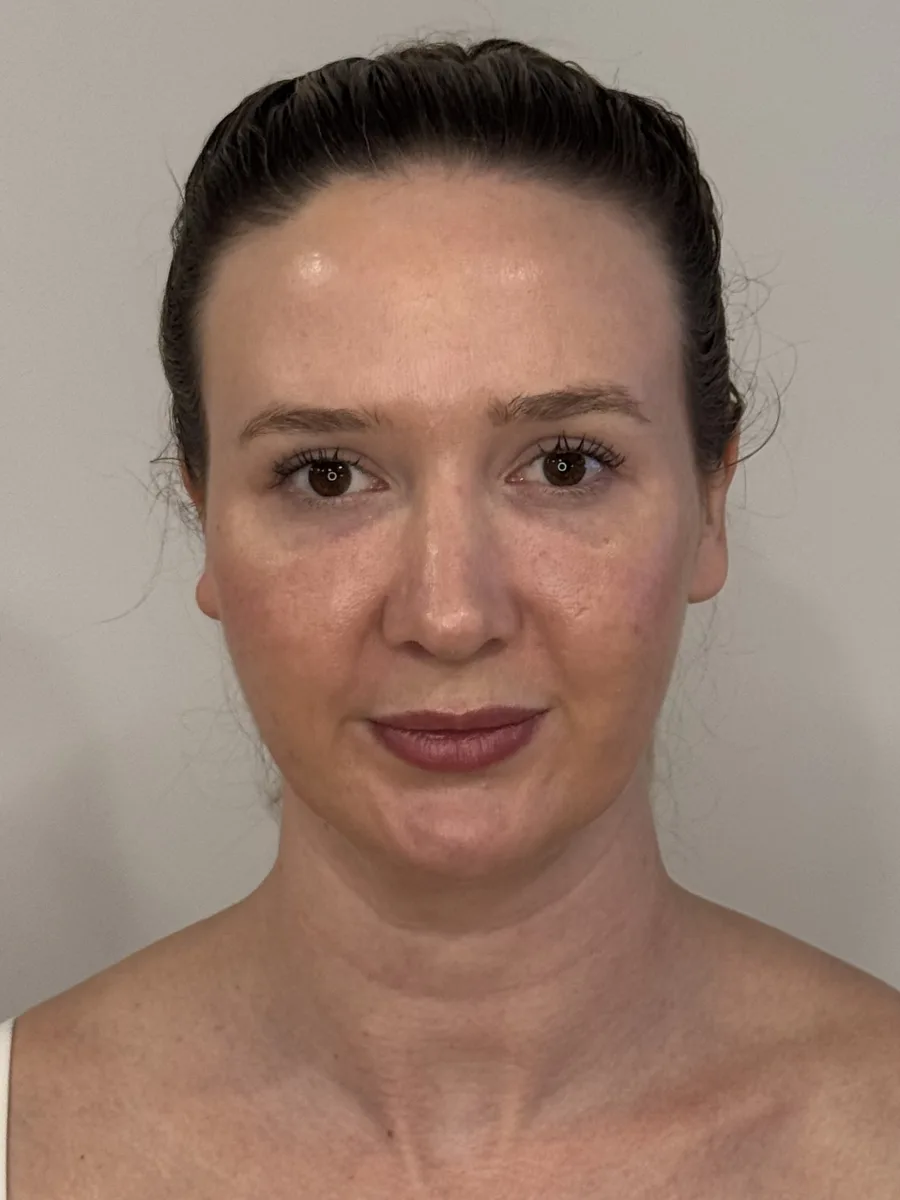 Facial Balancing after — Esthetic Finesse