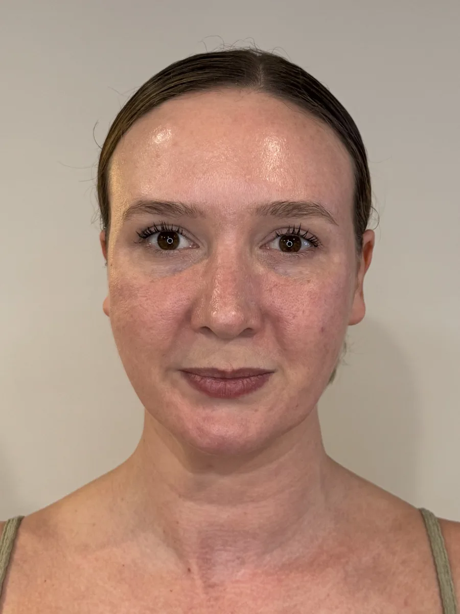 Facial Balancing before — Esthetic Finesse