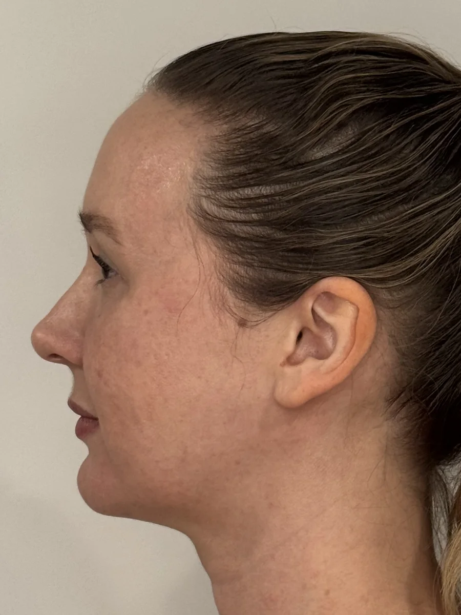 Profile Harmony after — Esthetic Finesse