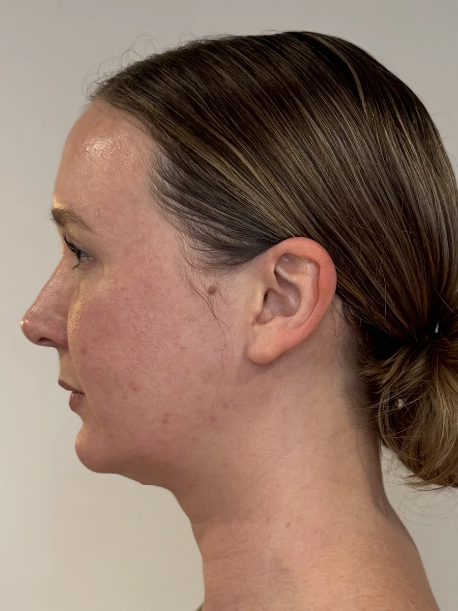 Profile Harmony before — Esthetic Finesse
