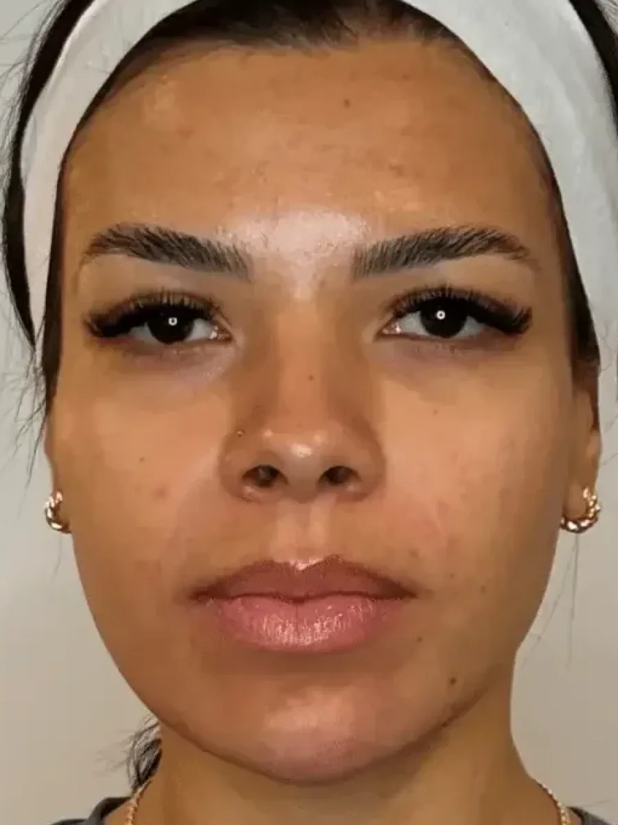 Full-Face Harmonization after — Esthetic Finesse