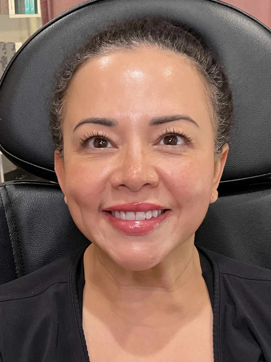 Full-Face Tox Balance after — Esthetic Finesse