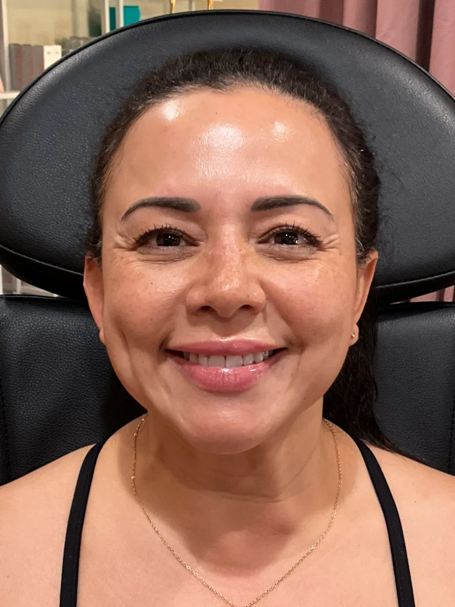 Full-Face Tox Balance before — Esthetic Finesse