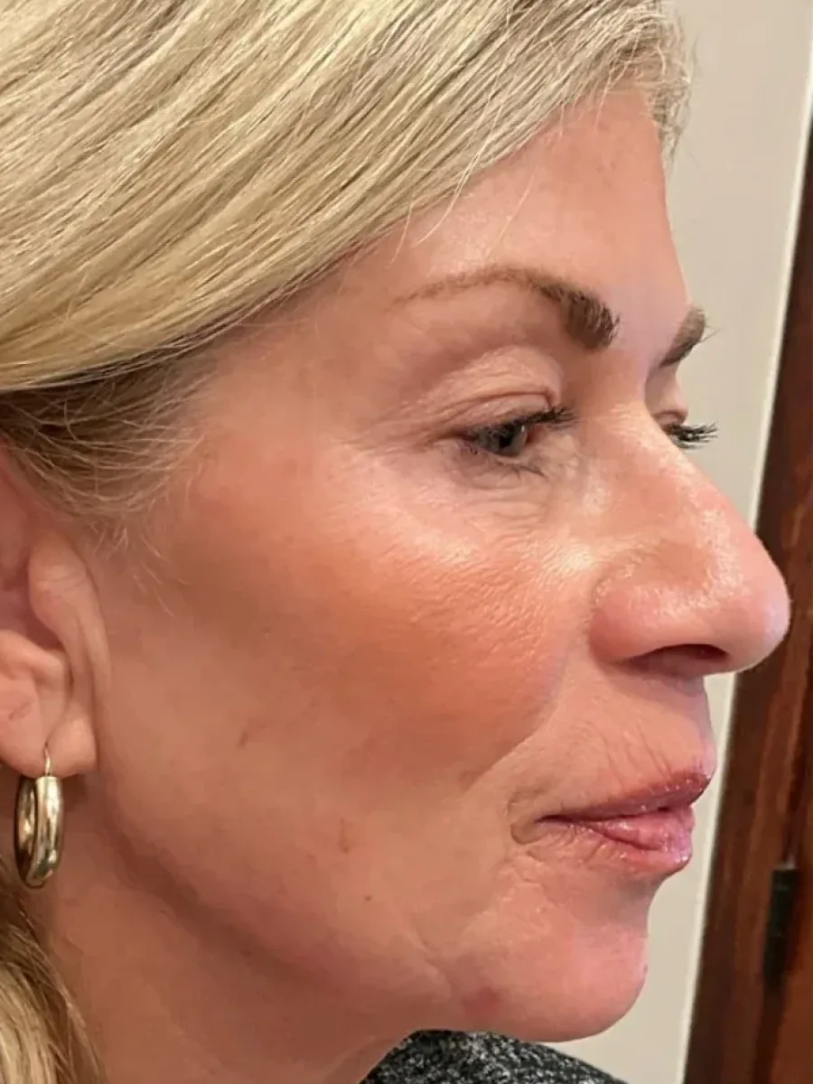 Jawline Definition after — Esthetic Finesse