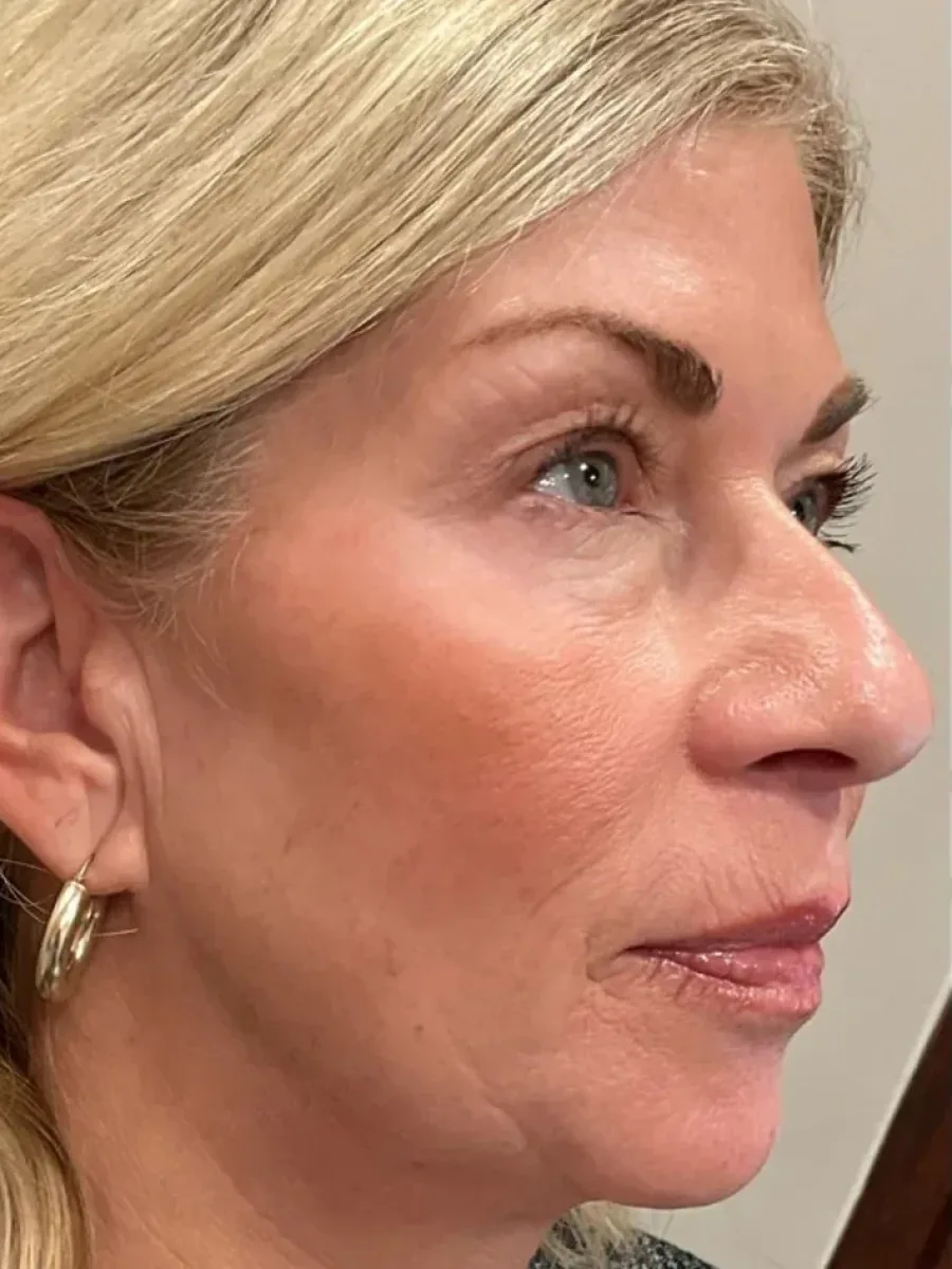 Jawline Definition before — Esthetic Finesse
