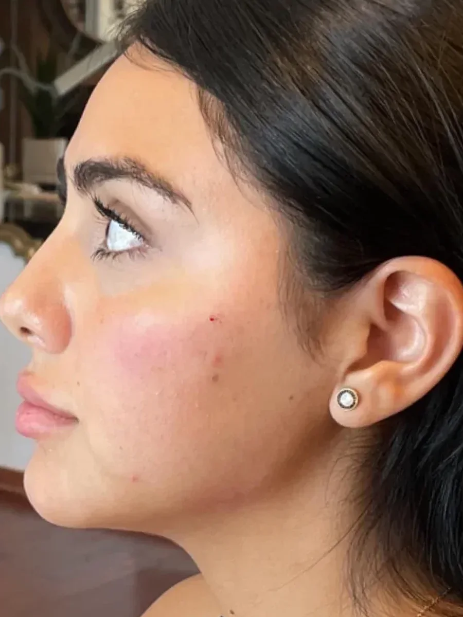 Jawline Contour after — Esthetic Finesse