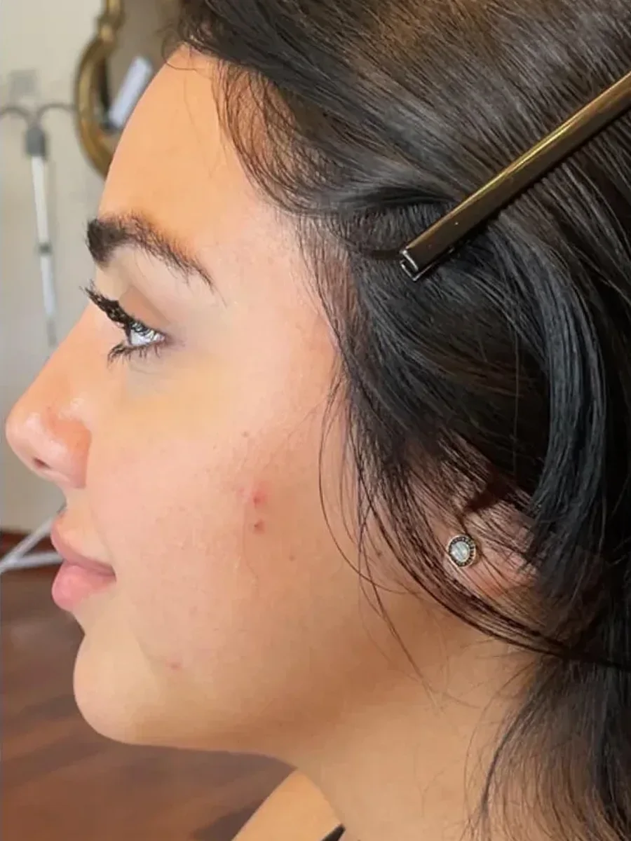 Jawline Contour before — Esthetic Finesse