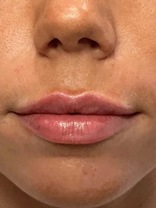 Lip Refinement after — Esthetic Finesse