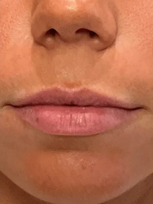 Lip Refinement before — Esthetic Finesse