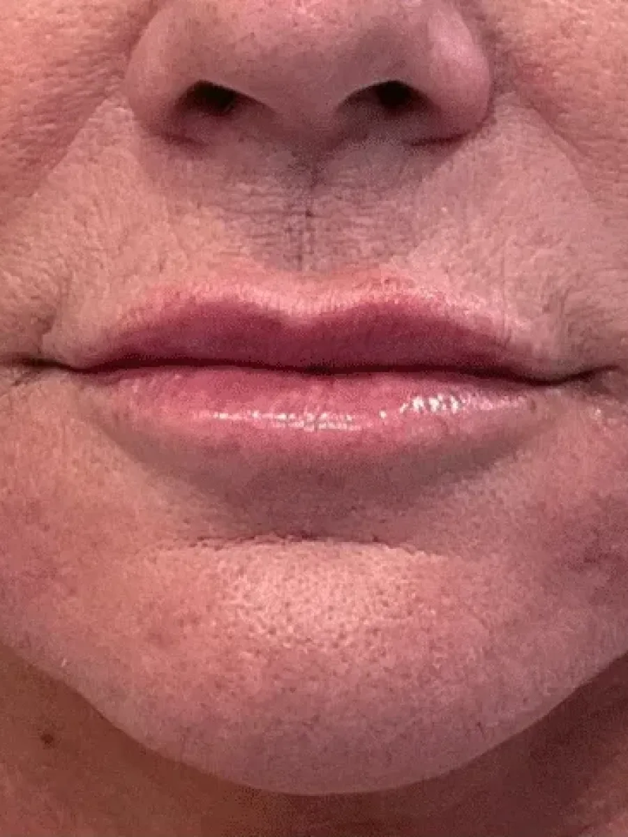 Lip Refresh and Chin Shadows after — Esthetic Finesse
