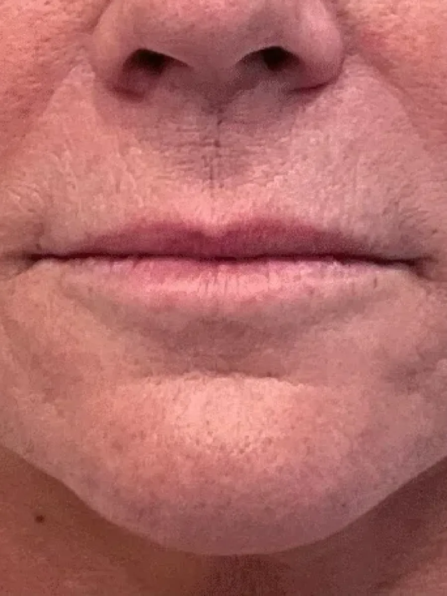 Lip Refresh and Chin Shadows before — Esthetic Finesse