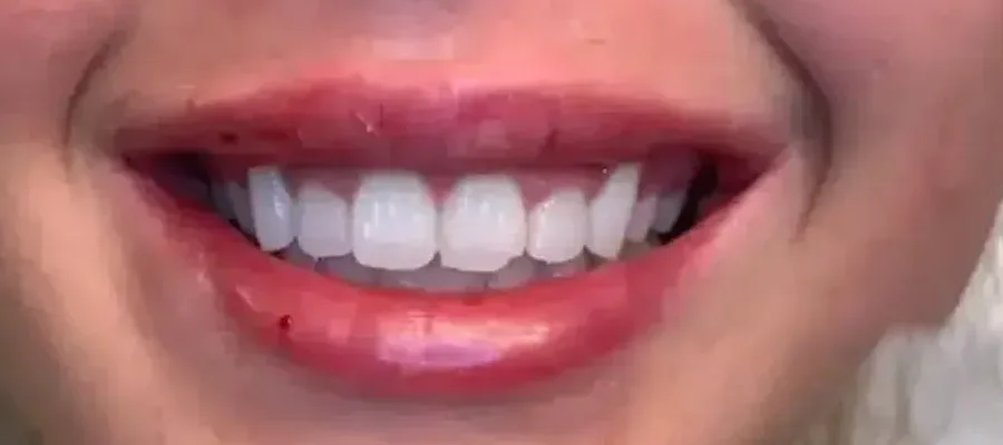 Gummy Smile Tox after — Esthetic Finesse