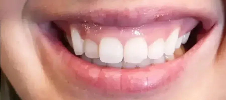 Gummy Smile Tox before — Esthetic Finesse